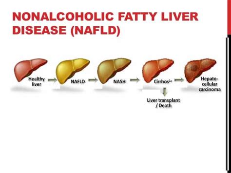 Nonalcoholic Fatty Liver Disease Inlifehealthcare