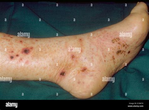 Vasculitis Of Legs Stock Photo Alamy