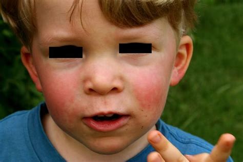 5 Things You Need To Know About Fifth Disease —