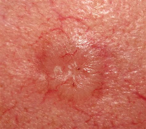 Basal Cell Carcinoma Removal Basal Cell Carcinoma Treatment