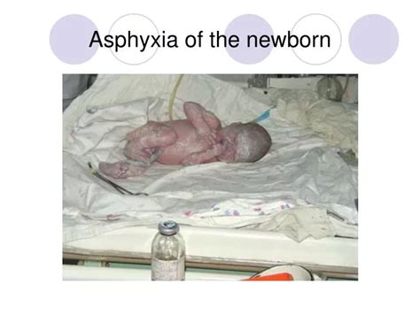 Ppt Asphyxia In Newborn Powerpoint Presentation Free Download Id