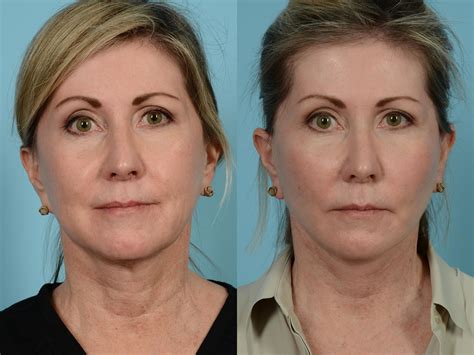 Faceliftminilift By Dr Sinno Before And After Pictures Case 717