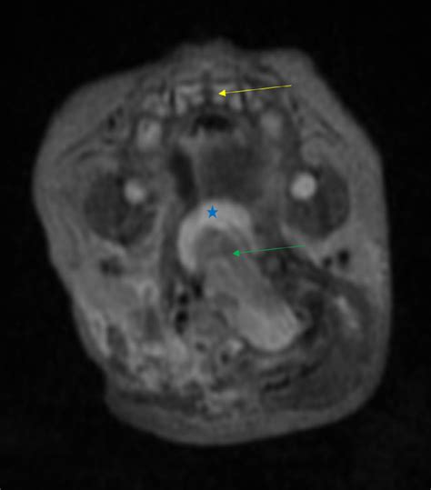 Brainstem Extending Into Oropharynx Axial T2 Weighted Mri Image At