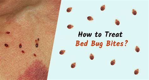 How To Treat Bed Bug Bites Bed Bug Bites Bug Bites Bed Bugs