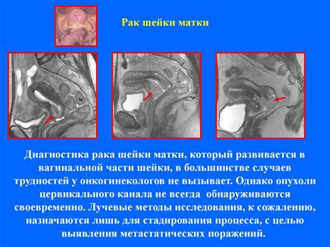 Как выглядит рак матки на узи Рак Шейки Матки МРТ Images and Photos finder