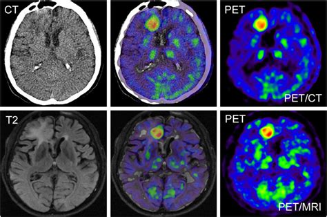Petct And Petmri Images Of 56 Y Old Patient With Glioblastoma