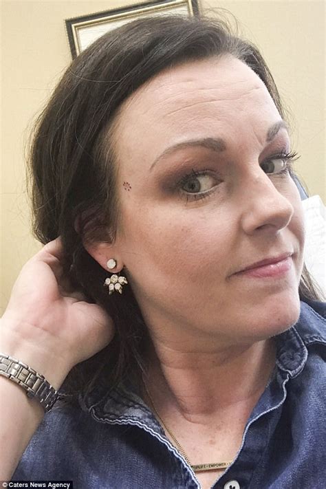 More than 2 people die of skin cancer in the u.s. Mother has a hole in her face due to skin cancer | Daily ...