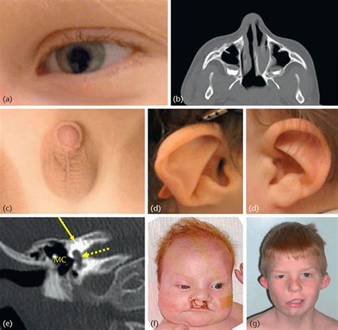 Here’s what you need to know about following a kidne. CHARGE syndrome causes, symptoms, diagnosis, life