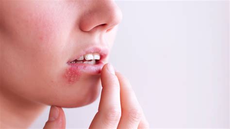 Differences Between Hsv 1 And Hsv 2 Oral And Genital Herpes Allure