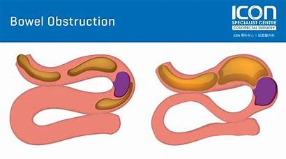 Bowel Obstruction Symptoms Dehydration Signs Perforation Intestines