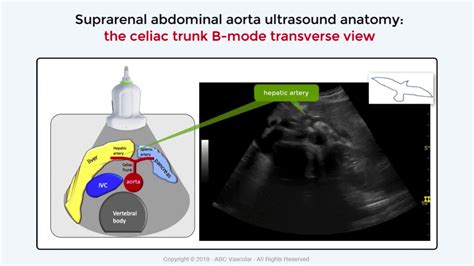 Celiac Trunk Ultrasound Appearance Vascular Ultrasound Learning Youtube