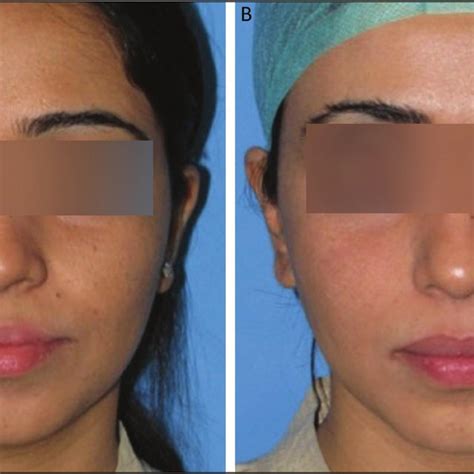 A Pre Procedural Image Showing Prominent Malar And Jowl Fat Pads B
