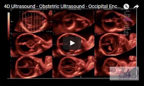 4D Ultrasound Obstetric Ultrasound Occipital Encephalocele In 4D