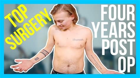 trans 4 years post top surgery dr garramone [cc] jeff a miller youtube