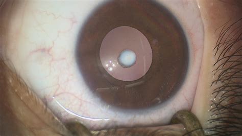 Congenital Cataract For Patients Gene Vision