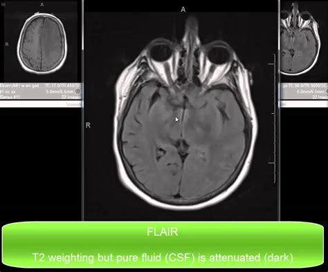 Introduction To Mri Pulse Sequences For The Brain Youtube