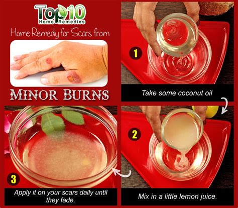 Home Remedies For Minor Burns Top 10 Home Remedies