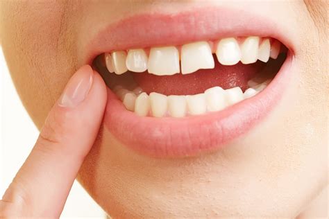 Tooth bonding | Smiles on Queen Dentistry | Cosmetic Dentistry Bolton