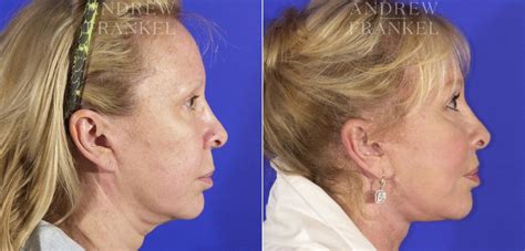 Midface Lift Photos Beverly Hills Ca Patient 4409