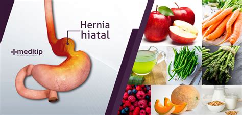 Dieta De La Hernia Hiatal Una Alternativa Contra Reflujo