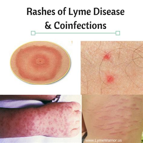Rashes Of Lyme Disease And Coinfections — Lyme Warrior