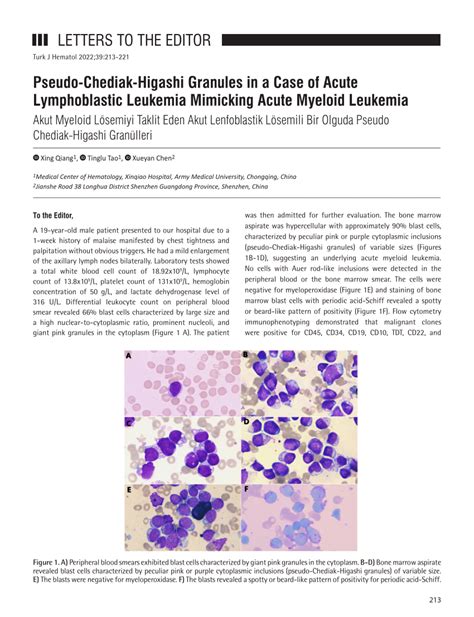 Pdf Pseudo Chediak Higashi Granules In A Case Of Acute Lymphoblastic