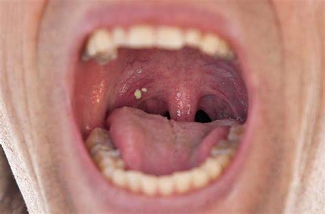 Can Tonsils Grow Back After Being Removed Tymoff An In Depth