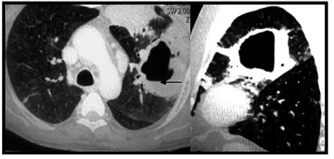 Axial And Coronal Ct Chest Showing A Large Irregular Shaped Cavity Left