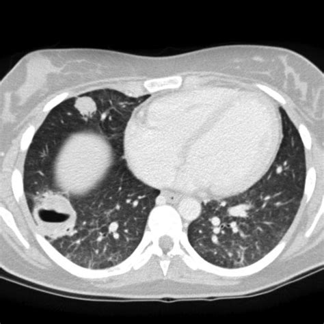 Granulomatosis With Polyangiitis Ct Wikidoc