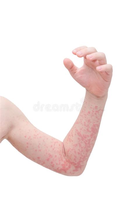 Child Arm Skin With Rash Over White Stock Image Image Of Patient