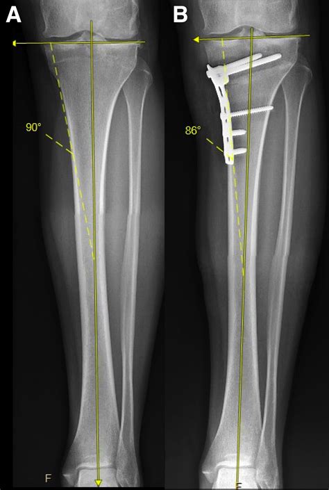 Technique For Medial Closing Wedge Proximal Tibia Osteotomy In The