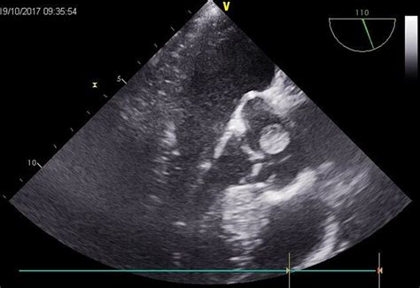Presentation Of Papillary Fibroelastoma Of The Aortic Valve With