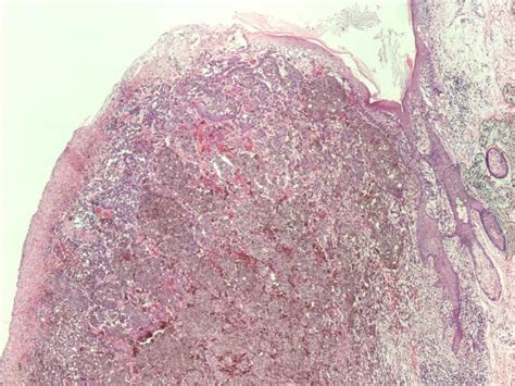 Pathology Outlines Nodular Melanoma