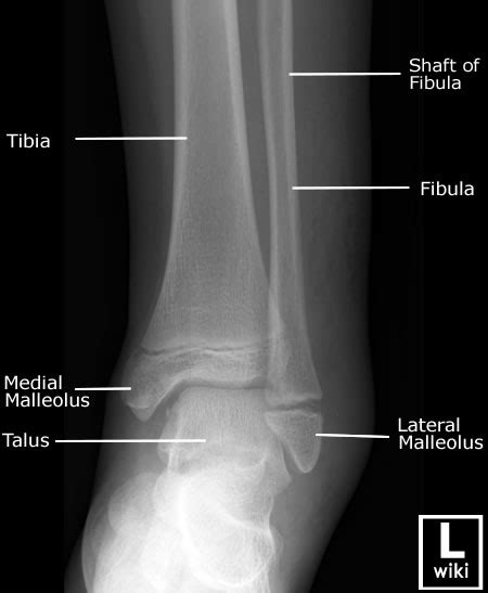 Ankle X Rays