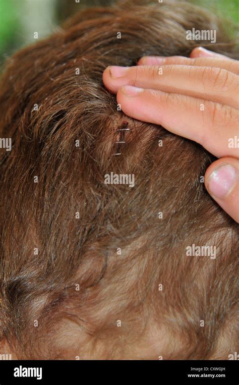 Head Wound Stitches Hi Res Stock Photography And Images Alamy
