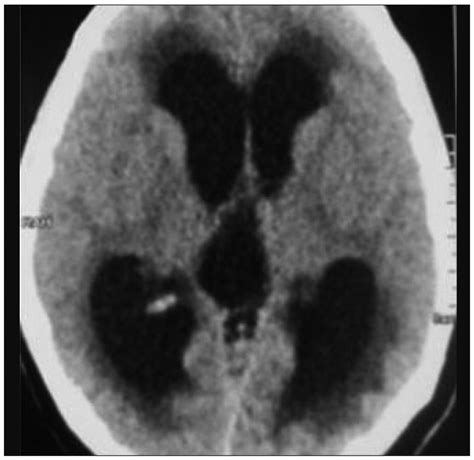 Ct Scan Brain Images Of First Case Axial Showing Hydrocephalus With