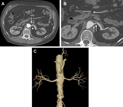 Ct Angiography Of The Renal Circulation Radiologic Clinics