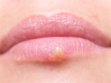 773,732 likes · 19,101 talking about this. HSV-1 - Natural treatments & home remedies