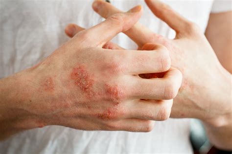 Eczema Cronico Della Mano Miglioramenti Significativi Della Malat