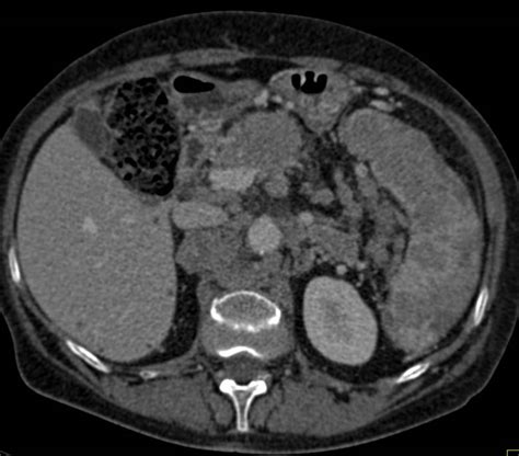 Lymphoma With Extensive Adenopathy And Splenic Infiltration Spleen