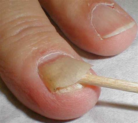 Nail Fungus Symptoms Causes Diagnosis And Treatment Natural Health News