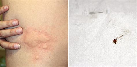 Baby Bed Bug Bites Pictures Pictures Photos