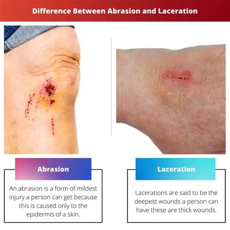 Abrasion Vs Laceration Difference And Comparison