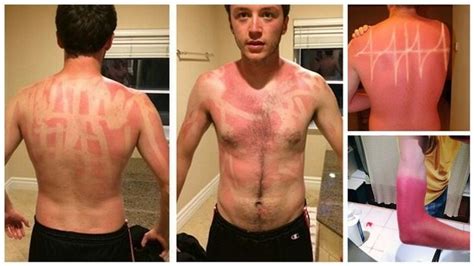 16 horribly hilarious sunburns that will make you want to slather on the spf funny sunburn
