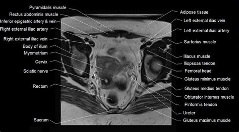 The inferior gluteal vessels, internal pudendal vessels, and sciatic nerve also traverse the greater sciatic foramen just inferior to the piriformis muscle (see female pelvis axials 6 and 7 and sagittals 1 and 2). mri female pelvis anatomy axial image 17 | Pelvis anatomy ...