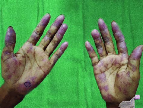 Multiple Erythematous To Violaceous Plaques Over Bilateral Palms Over