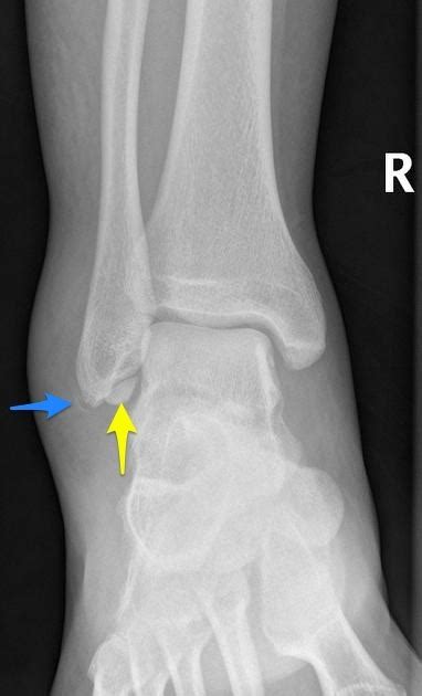 Avulsion Fracture Ankle