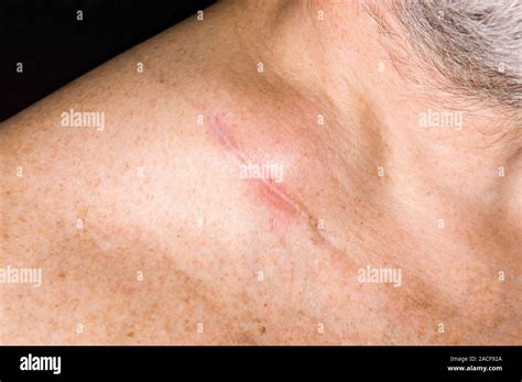 Swollen Lymph Gland At The Base Of A 62 Year Old Mans Neck This