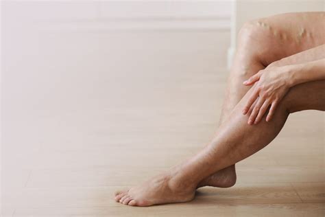 Is It Dangerous To Have Bulging Veins In Legs Melbourne