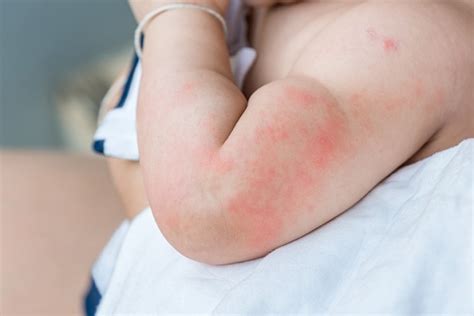How To Deal With Skin Rashes In Babies And Toddlers